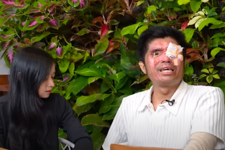 Potret Agus Salim, korban penyiraman air keras ketika tampil di acara podcast milik Denny Sumargo