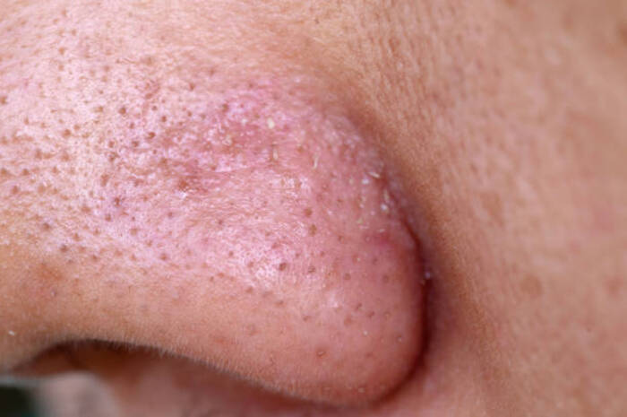 Ket Foto: Ilustrasi foto hidung yang berkomedo (Foto/Pixabay/Komedo)