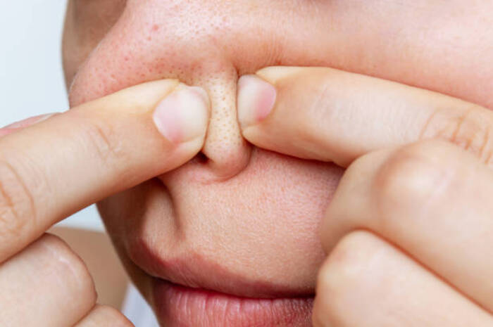 Ket Foto: Ilustrasi foto hidung yang berkomedo (Foto/Pixabay/Komedo)