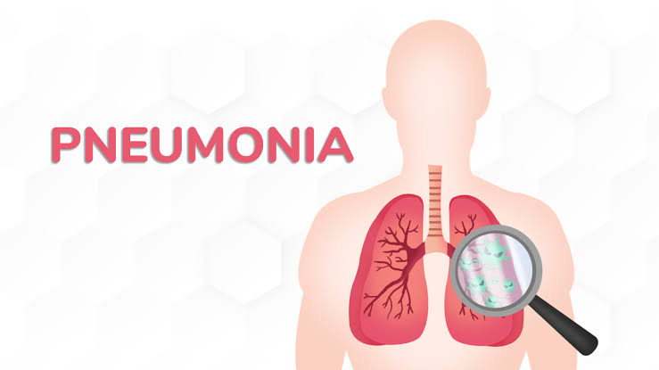 <p>Ket. Gambaran ketika terkena pneumonia (Foto/Hermina) </p>