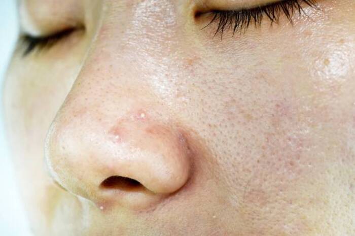 Ket Foto: Ilustrasi foto hidung yang berkomedo (Foto/Pixabay/Komedo)