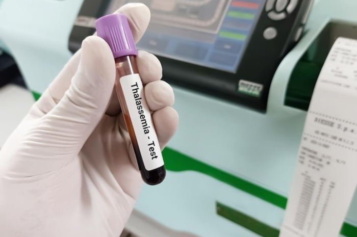 <p>Ket Foto: Thalasemia adalah salah satu penyakit yang wajib diketahui sebelum menikah karena dapat menyebabkan banyak masalah kesehatan (Foto/Freepic) </p>
